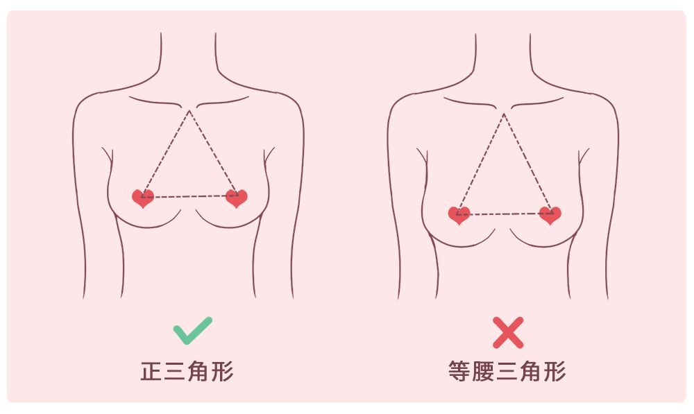 劉燕釀制：胸外擴(kuò)是什么原因造成的？胸外擴(kuò)如何改善？